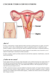 cancer de útero o cervico uterino
