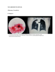 NOCARDIOSIS PULMONAR (Pulmonary Nocardiosis) #1 imágenes