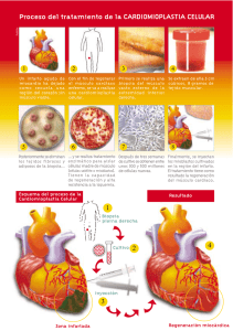 infográfico de la cardiomioplastia