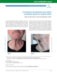Contractura del platisma secundaria a parálisis facial