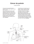 Lung Cancer - Spanish - Health Information Translations