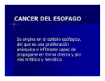 Carcinoma del Esófago 2