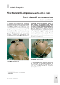 Metástasis mandibular por adenocarcinoma de colon
