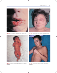 195 Fig. 2.29. Primoinfección herpética: lesión bucal y labial. Fig
