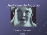 Síndrome de Noonan