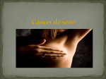 Cancer de seno