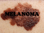melanoma - SlideBoom