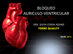 Bloqueo AV. - Hospital Cardiológica Aguascalientes