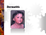 Manejo de la dermatitis atópica