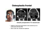Osteoplastia frontal