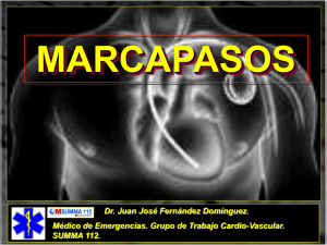 MARCAPASOS DISFUNCIONANTE. TIPOS DE MARCAPASOS