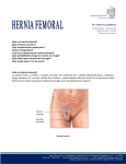 ¿Qué es la hernia femoral? - coloproctologia