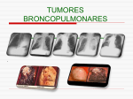TUMORES BRONCOPULMONARES