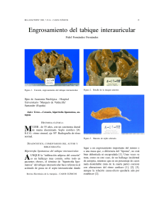 Engrosamiento del tabique interauricular