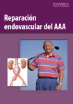 Reparación endovascular del AAA