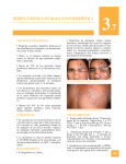 herpes zóster y neuralgia postherpética