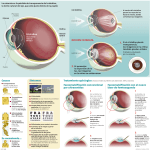 Causas Se recomienda... Síntomas Cristalino OJO CON CATARATA