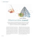 Obstrucción nasal